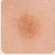Close-up example of a small pigmentation spot treatment area